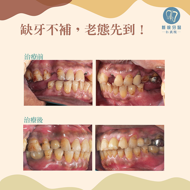 新悅美學牙醫-戚先生的補牙回春記的第3張圖片